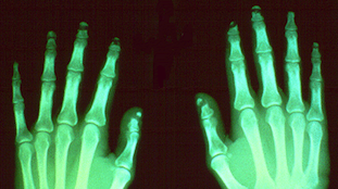 hand x-rays